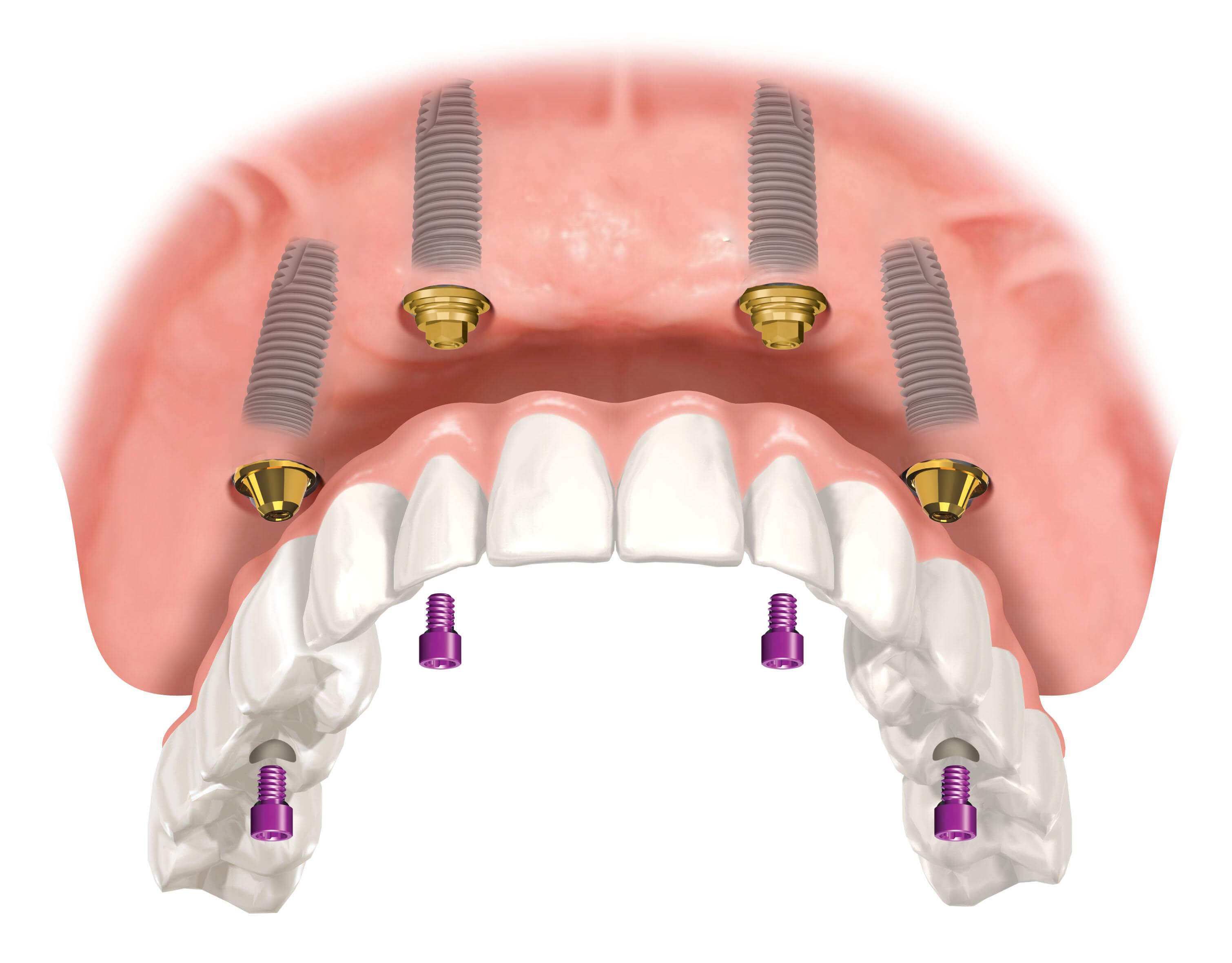 Протезирование зубов в клинике Семейная стоматология
