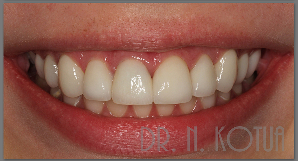 Протезирование зубов в клинике Семейная стоматология