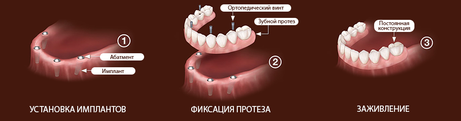 Импланты All-on-4 Томск Рузского протезирование зубов в томске отзывы