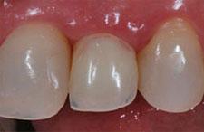 Имплантация зубов в клинике Семейная стоматология